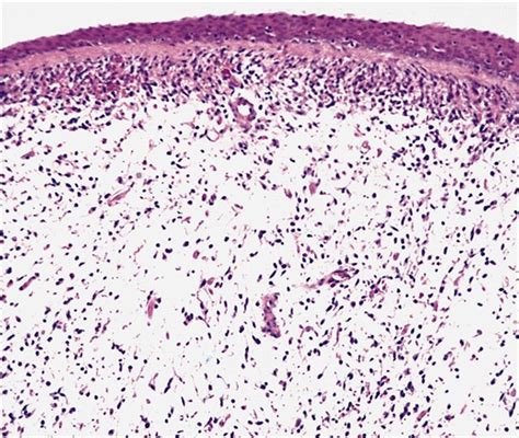 Pathology Outlines Embryonal Rhabdomyosarcoma