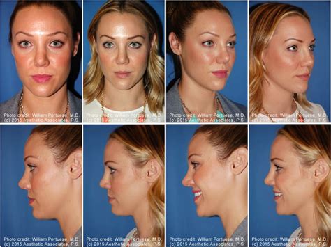 Rhinoplasty Chin Implant Before And After Rhinoplasty Patients