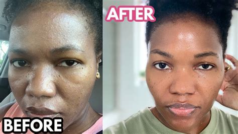 Tretinoin How I Use It For A Flawless Uniform Dark Skin Stop Acne