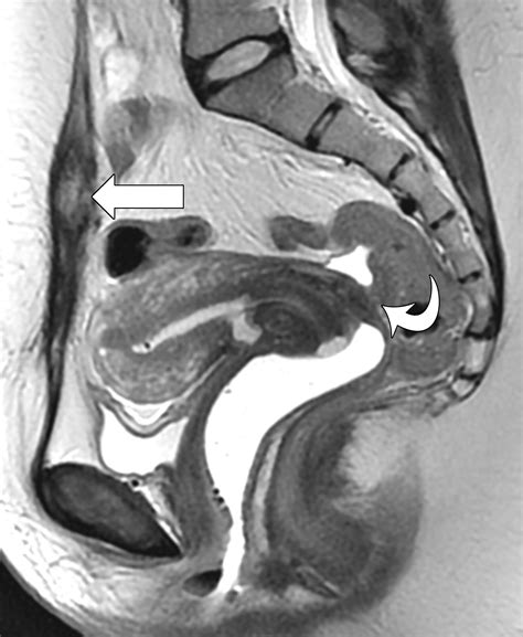 Atypical Sites Of Deeply Infiltrative Endometriosis Clinical Characteristics And Imaging