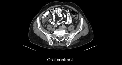 Abdominal Ct Phases • Litfl • Radiology Library