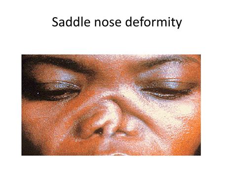 Saddle Nose Deformity Syphilis