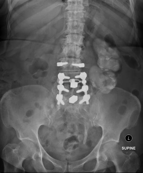 Nephrocalcinosis Urology News