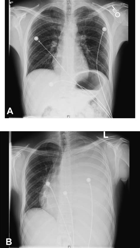 A Nephropleural Fistula Complicated By Distal Ureteral Obstruction