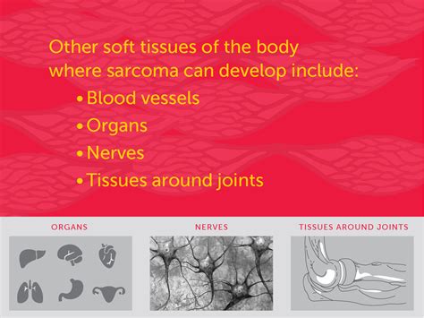 Signs And Symptoms Of Soft Tissue Sarcomas Dana Farber Cancer Institute