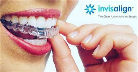Элайнеры Invisalign - Стоматология "Алекс" в Жуковском