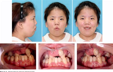 Figure 1 From Surgical Orthodontic Treatment For Severe Malocclusion In