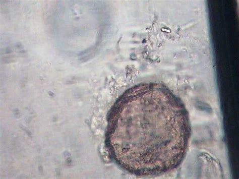 Entamoeba Histolytica Vs Entameoba Coli