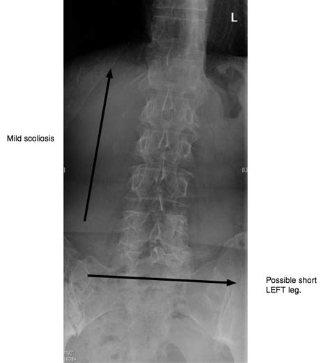 Lumbar Facet Arthropathy Spondylolysthesis with lower back & leg pain.