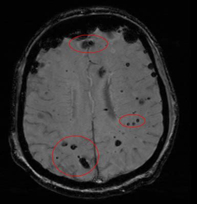 Cavernous Hemangioma Brain