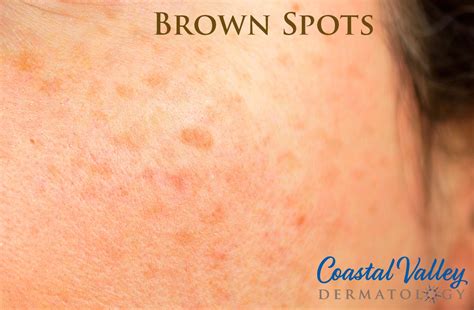 Brown Spot Treatments In Monterey CA Coastal Valley Dermatology