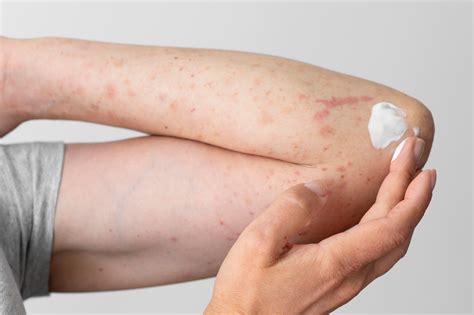 Dermatite atópica saiba o que é sua causa e sintomas