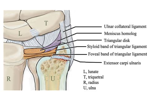 A type 2 ulnar styloid nonunion | Download Scientific Diagram