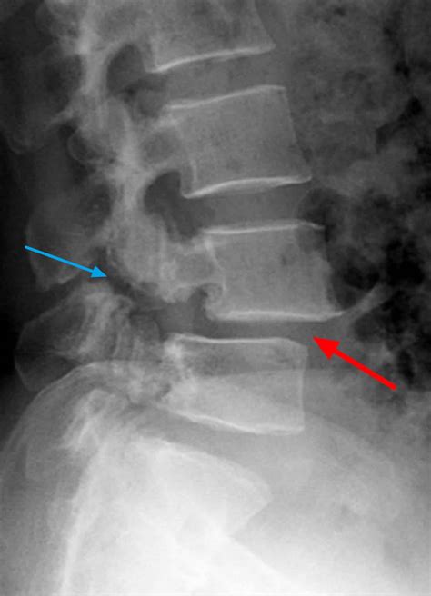 Spondylolisthesis Causes Symptoms Diagnosis Grades Treatment