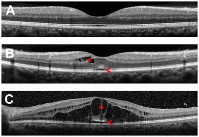 Frontiers Mechanisms Of Macular Edema