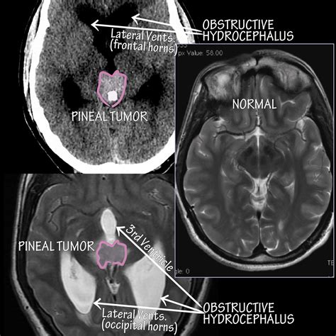 Neuroanatomy Glossary: Pineal Region Tumors (aka Pinealoma) | ditki