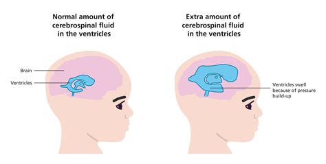 Hydrocephalus Types, Causes, Symptoms, Diagnosis,, 58% OFF