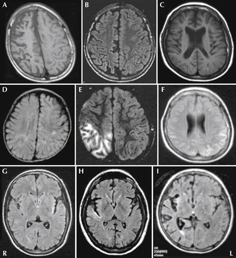 JLE Epileptic Disorders Temporal Changes In Brain MRI Findings In