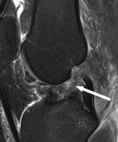 Popliteofibular Ligament Mri