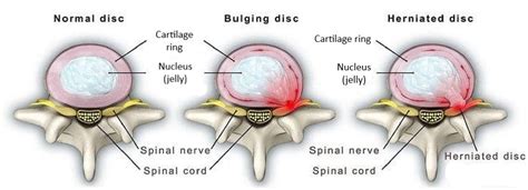 Back pain: Disc protrusion vs. herniation - Physiovive