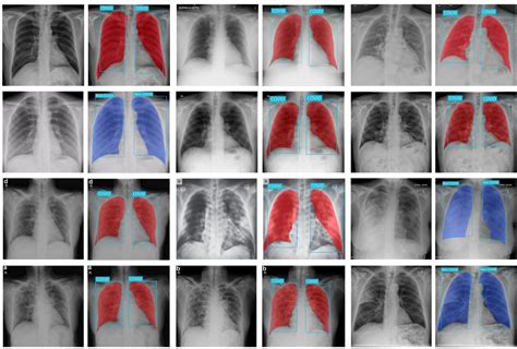 An Efficient Method Of Detection Of COVID 19 Using Mask R CNN On Chest