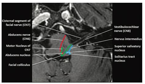 Th Of Facial Nerve Mri