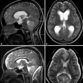 A And B Pre Operative T2W Sagittal And Axial MRI Of Brain Showing