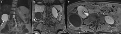 Retroperitoneal Schwannoma A Coronal T Weighted Image Demonstrates A