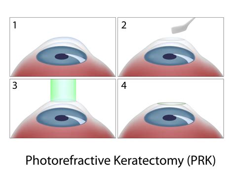 Prk Surgery Honolulu Hi Photorefractive Keratectomy