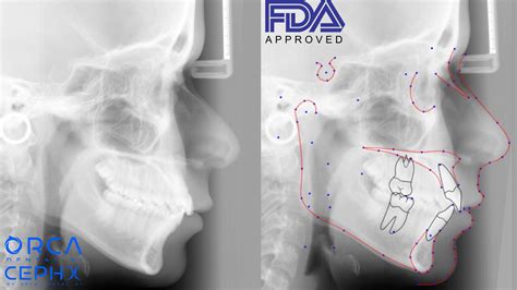 Orca Dental Ai S Cephx Secures Fda Clearance For Ai Cephalometric