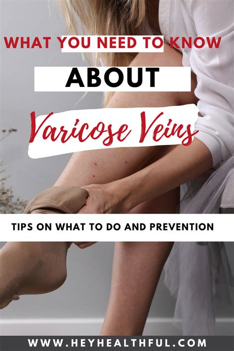 What You Need To Know About Varicose Veins