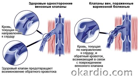 Варикоцеле у мужчин: симптомы, лечение, что это такое
