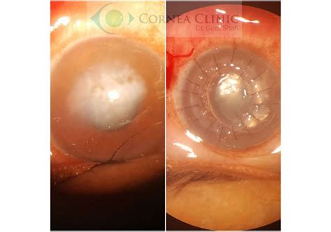 Corneal Transplants And Lamellar Keratoplasty Dalk Dsek Dmek Cornea