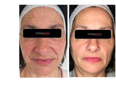 Dermafrac™ Micro Infusion Revive Skin And Laser