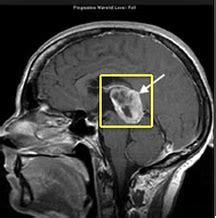 Pineoblastoma - The Anatomy of Brain Tumors