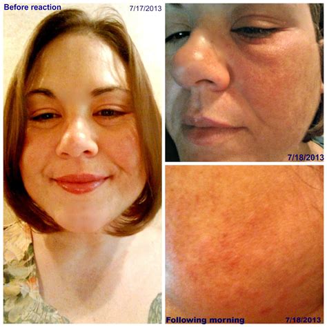 For The Love Of Natalee: Allergic to Snuggle Fabric Softener? Yep!