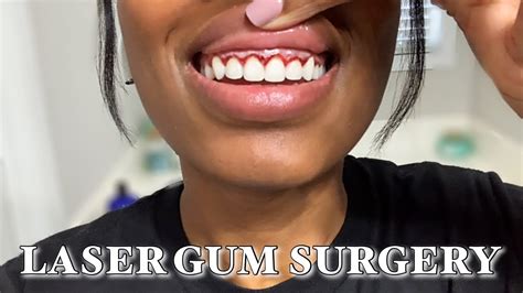 LASER GUM SURGERY TEETH JOURNEY Gum Contouring Gummy Smile Crown