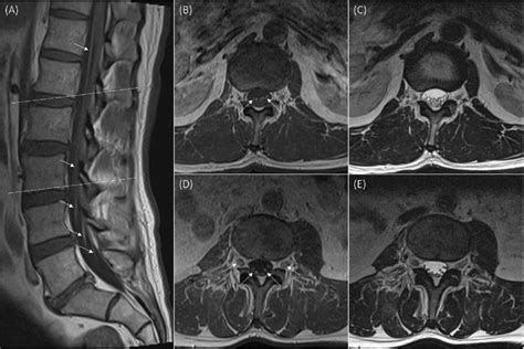 Mri Lumbar Spine T Post Gadolinium Sagittal A And Axial B D