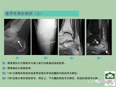 疲劳性骨折的影像诊断 知乎