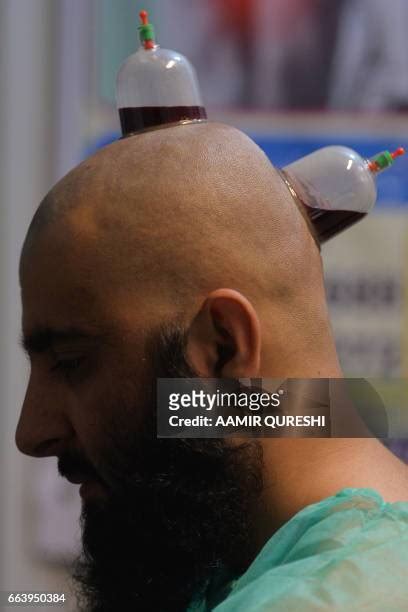 Wet Cupping Therapy Photos And Premium High Res Pictures Getty Images