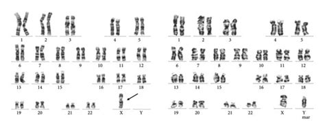 The Results Of G Banding Karyotype Analysis In Case 1 Showed The 45 X Download Scientific