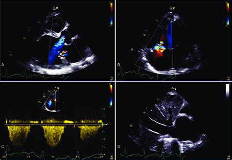 Echocardiography confirmed valvular heart disease and biventricular ...