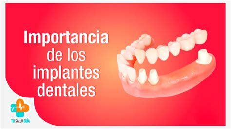 Importancia de los implantes dentales Tu Salud Guía YouTube