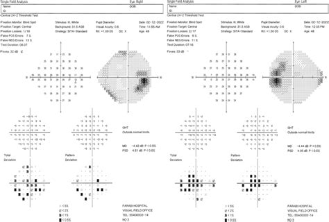 Visual field perimetry showing enlargement of blind spot in both eyes ...