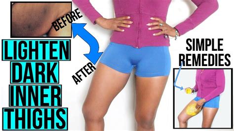 How To Lighten Dark Inner Thighs Fast And Naturally Youtube Lighten Inner Thighs Lighten