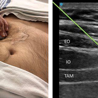 Posterior Transversus Abdominis Plane TAP Block The Left Image Shows