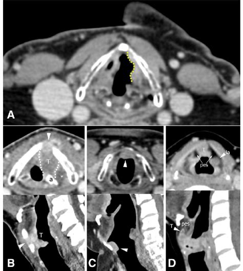 A Ct Scan Axial Plane Showing A Glottic Tumor Dotted Line Involving