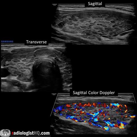 Pseudonodular appearance of Hashimoto’s thyroiditis on ultrasound : r ...