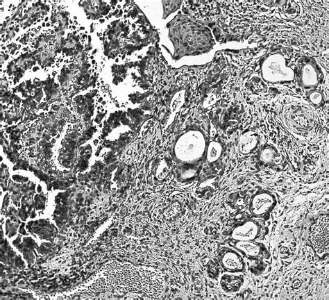 Pathology Outlines Cervix Clear Cell Carcinoma Adenocarcinoma 116388