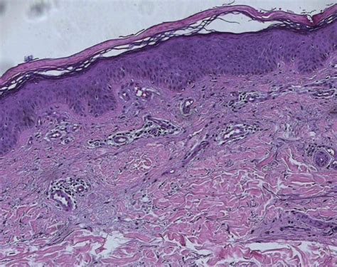 Skin Biopsy Papillomatosis Hyperkeratosis Parakeratosis Perivascular